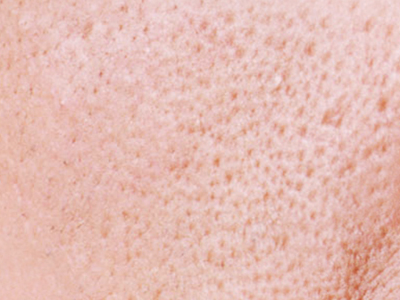 女人怎么杜绝毛孔粗大 - 3023.com