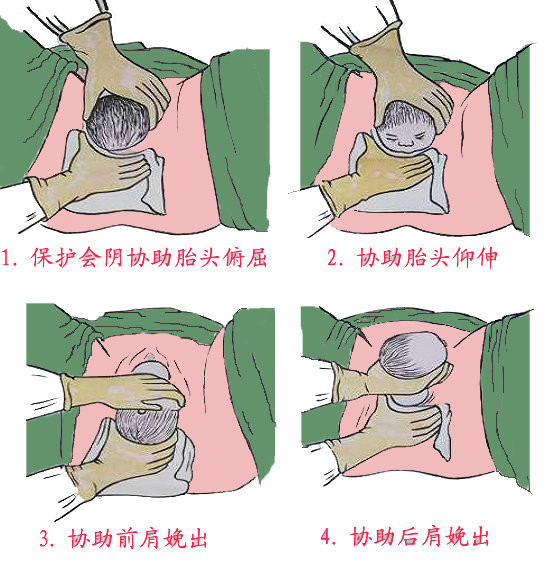 顺产生得快, 你还得这样用力