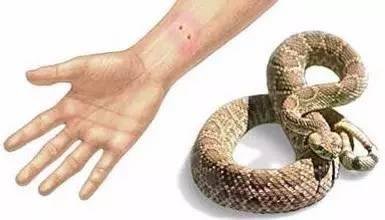 被毒蛇咬后用嘴吸毒血? 还是切开挤血? - 3023