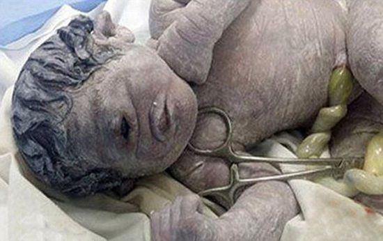 畸形婴儿出生吓坏医生 悲剧源于妈妈!